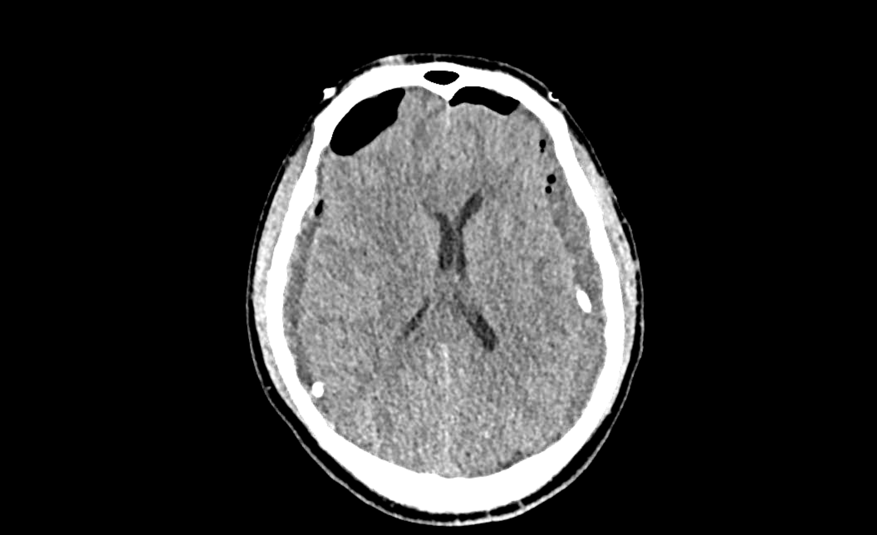 Cerveau